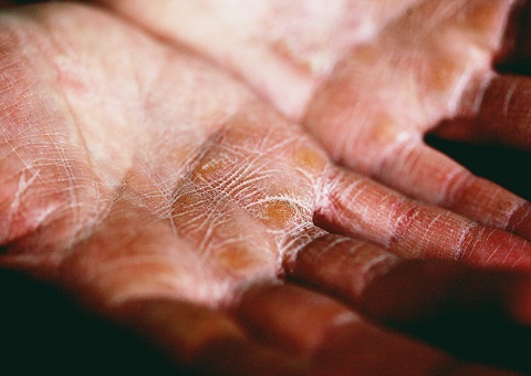 Close up of chapped hands